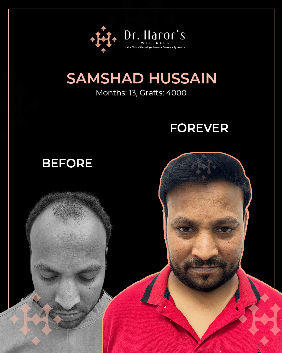 3 - Before and After